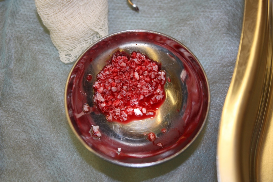 Костная матрица и стимуляторы роста имплантация олл он фо